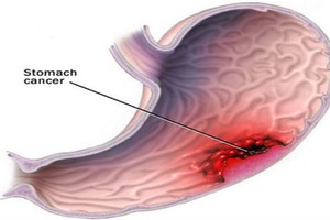 Thực phẩm gây ung thư dạ dày cao lại được nhiều người mê đắm