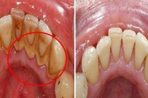 Cao răng bật ra từng mảng lớn chỉ với thứ rẻ tiền này