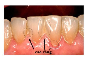 Cao răng tự rụng ra, hôi miệng cũng hết hẳn với nguyên liệu này