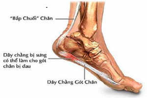 Triệu chứng báo hiệu bệnh viêm khớp