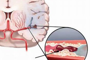 Cách điều trị thiếu máu não hiệu quả