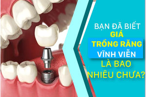 Bạn đã biết giá trồng răng vĩnh viễn là bao nhiêu chưa?