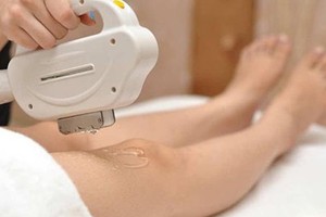 Bạn không thể lờ đi 9 điều này khi quyết định triệt lông bằng laser