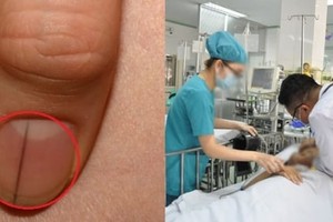 5 dấu hiệu bất thường ở ngón tay cảnh báo bệnh nguy hiểm