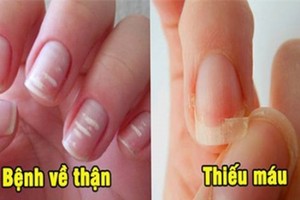 6 dấu hiệu ở móng tay cảnh báo bệnh nguy hiểm, đừng chủ quan