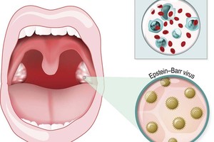 Một số bệnh do virus lây truyền qua nụ hôn