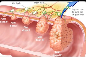 Đối tượng hay “dính” ung thư đại tràng