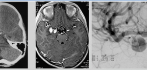 Đặt stent cứu trẻ 11 tuổi bị phồng mạch máu não