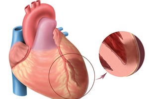 Kẹt van do máu cục vì không dùng thuốc chống đông