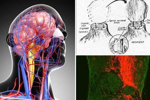 Bác sĩ Việt Nam nói về tính khả thi của ca ghép đầu người