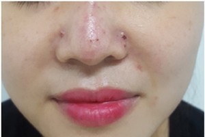 Một phụ nữ bị tắc mạch sau khi tiêm filler nâng mũi vài giờ