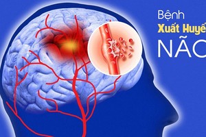 Loạt biểu hiện không ngờ là dấu hiệu xuất huyết não