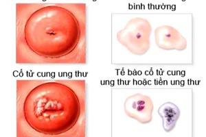 Cách dễ dàng phát hiện ung thư cổ tử cung