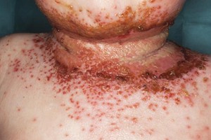 Ngừa được ung thư da nhờ có eczema?