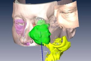 Tái tạo khuôn mặt cho bệnh nhân ung thư bằng công nghệ 3D