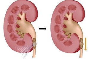 Chi tiết quy trình tán sỏi thận