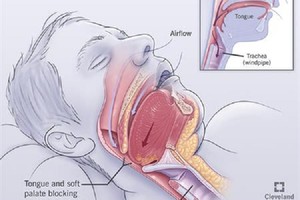 Biến chứng nguy hiểm của hội chứng ngưng thở khi ngủ