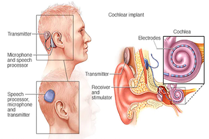 Loạt biến chứng nguy hiểm khi cấy ốc tai điện tử