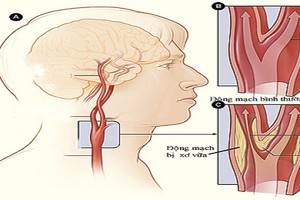 Cách giảm biến chứng thiểu năng tuần hoàn não