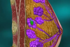 Cách nhận biết sớm ung thư vú