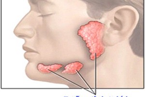 Các loại ung thư đầu cổ thường gặp (2)