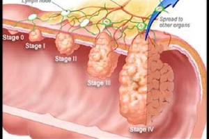 Công cụ mới phát hiện sớm ung thư đại trực tràng