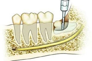 Tại sao không thể nhổ hết răng khôn cùng một lúc?