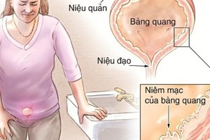 12 bài thuốc hỗ trợ điều trị viêm bàng quang cực hiệu quả