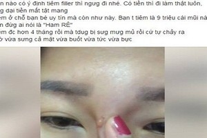 Hotgirl bị chảy dịch mủ sau tiêm filler nâng mũi 