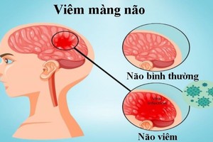 Nhận biết triệu chứng viêm màng não ở trẻ em, chớ dại bỏ qua