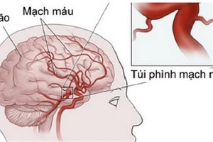 Phình mạch máu não – mối nguy chết người chớ coi thường