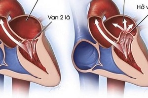 Hở van tim có nguy hiểm không, khi nào cần phẫu thuật?