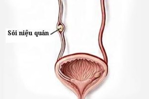 Biến chứng khó lường của sỏi niệu quản, cách phòng tránh