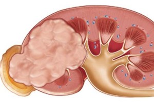 Bỏ ngay 5 thói quen này nếu không muốn chết sớm vì ung thư thận