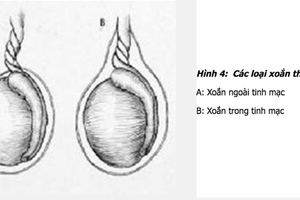 Đột ngột đau dữ dội 'hạt cà', thiếu niên 14 tuổi mất cơ hội làm cha