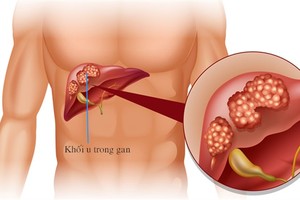 Bệnh gan ông Trần Bắc Hà mắc dễ dẫn đến tử vong như thế nào?