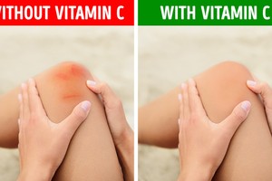 10 dấu hiệu sớm cảnh báo cơ thể đang thiếu vitamin C trầm trọng