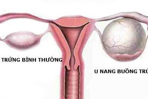 Tưởng con gái đau bụng do rối loạn tiêu hóa, mẹ choáng váng biết sự thật