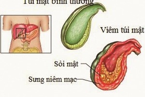 Nguyên nhân bé 9 tuổi đã bị sỏi mật khiến bố mẹ hết hồn