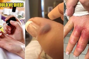 Suýt mất mạng vì nhiễm virus ăn thịt khi đi làm móng tay 