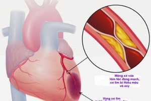 Cụ bà tử vong trên máy bay VNA: Phòng nhồi máu cơ tim thế nào?