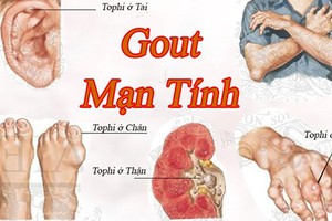 Kinh hoàng hình ảnh bệnh gout tàn phá cơ thể