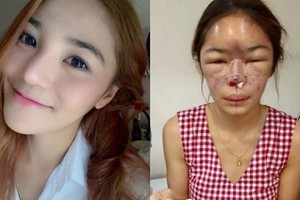 Sốc với gương mặt biến dạng vì phẫu thuật thẩm mỹ thất bại