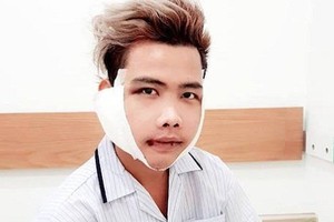 "Giật mình" trước nhan sắc của Tùng Sơn sau phẫu thuật thẩm mỹ