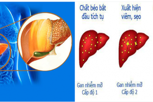 Cách giảm cả mỡ máu và gan nhiễm mỡ cùng 1 lúc