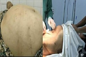 Tưởng béo bụng, đi khám mới phát hiện khối u gần 20kg