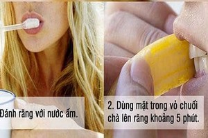 Mẹo hay lấy cao răng bằng vỏ chuối