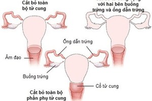 Cắt tử cung có ảnh hưởng chuyện phòng the?