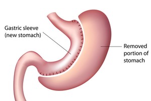 "Soi" phương pháp giảm cân được cho hiệu quả nhất hiện nay