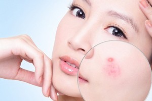 Đi spa thường xuyên da mặt vẫn ngày càng xấu vì sai lầm này